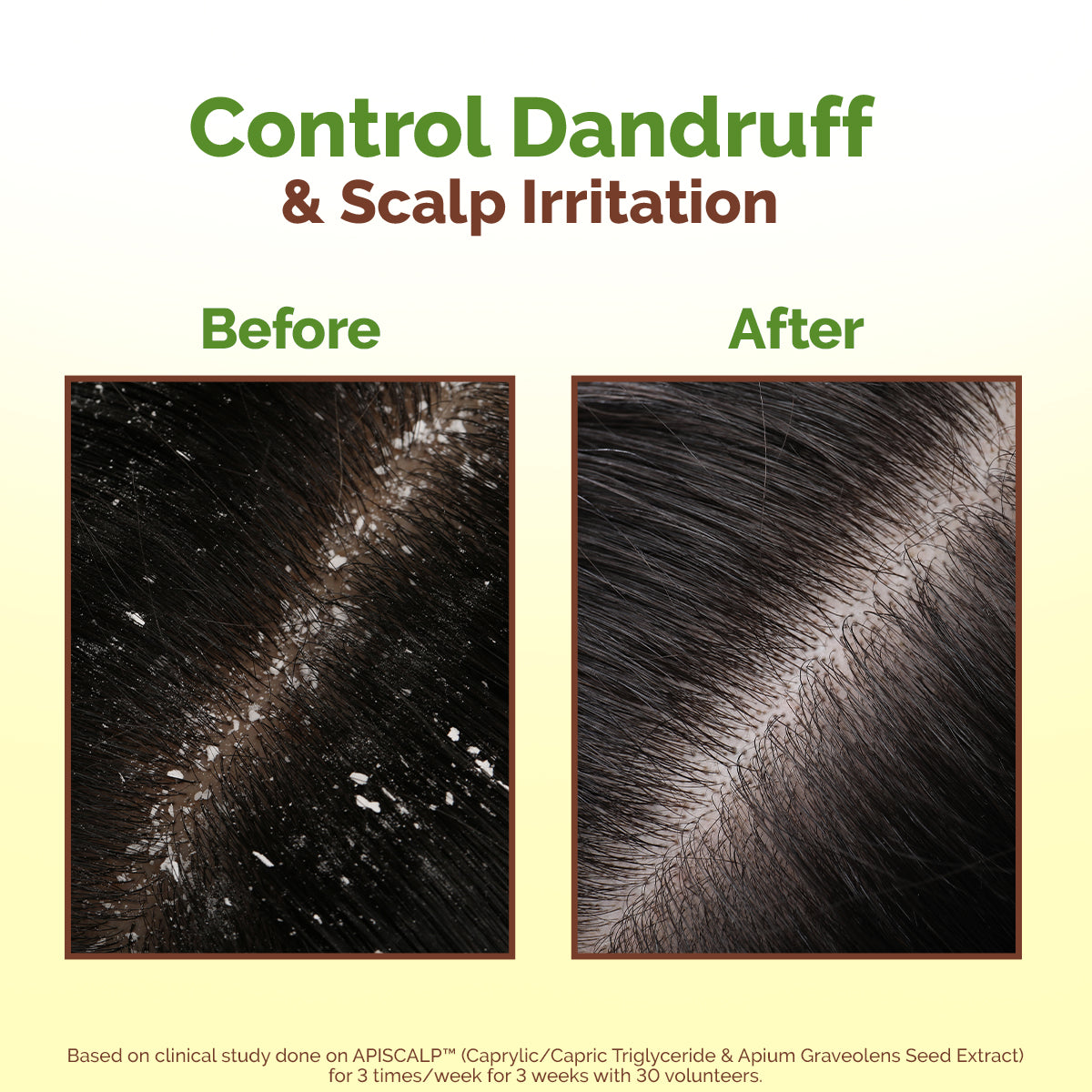 Lemon Anti-Dandruff Hair Oil