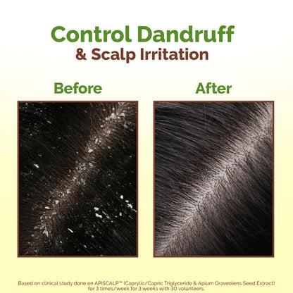 Lemon Anti-Dandruff Hair Oil